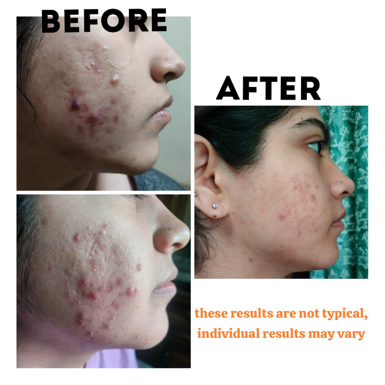 Acne Clearance Before and After